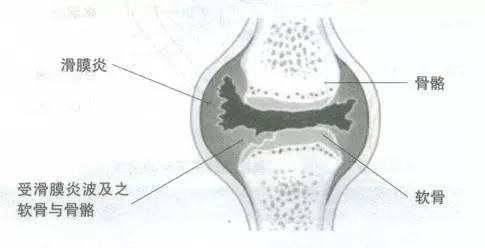 nba滑膜炎 球事膝盖滑膜炎的症状(3)