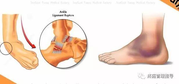 nba崴脚后怎么恢复的 NBA球星脚踝扭伤的处理方法(18)