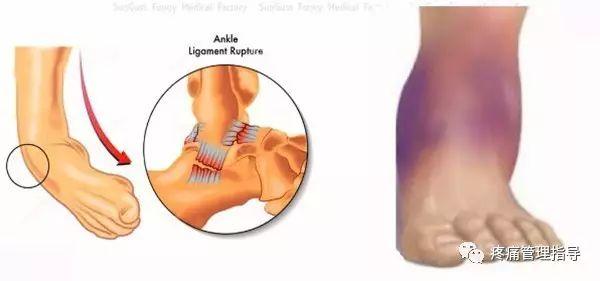 nba崴脚后怎么恢复的 NBA球星脚踝扭伤的处理方法(19)