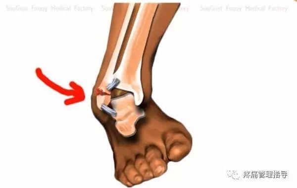 nba崴脚后怎么恢复的 NBA球星脚踝扭伤的处理方法(21)