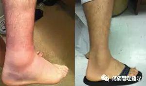 nba崴脚后怎么恢复的 NBA球星脚踝扭伤的处理方法(42)