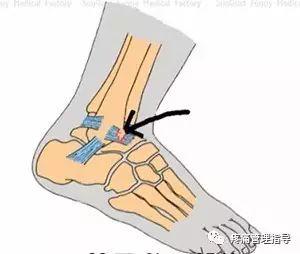 nba崴脚后怎么恢复的 NBA球星脚踝扭伤的处理方法(50)