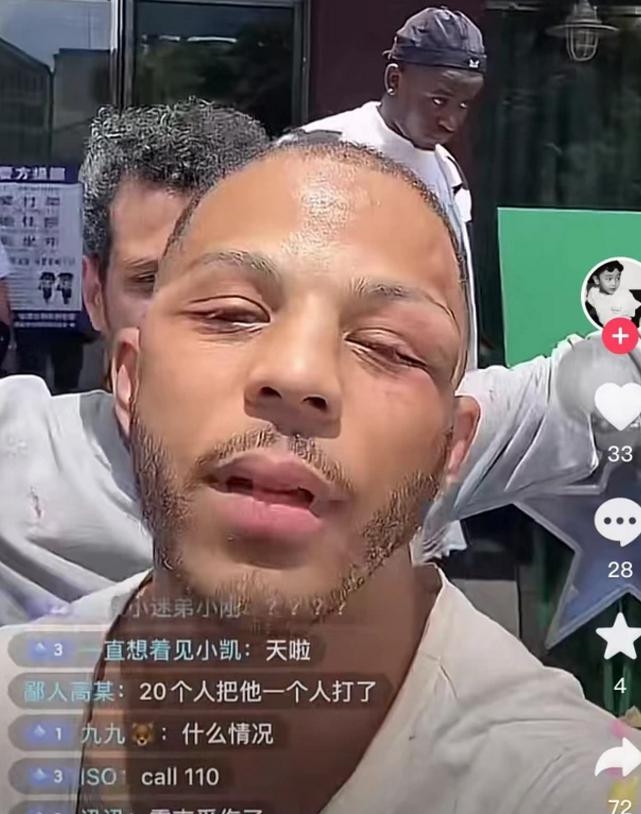 广东男篮再遭争议！宏远训练师被打，眼眶直接被打肿了(2)