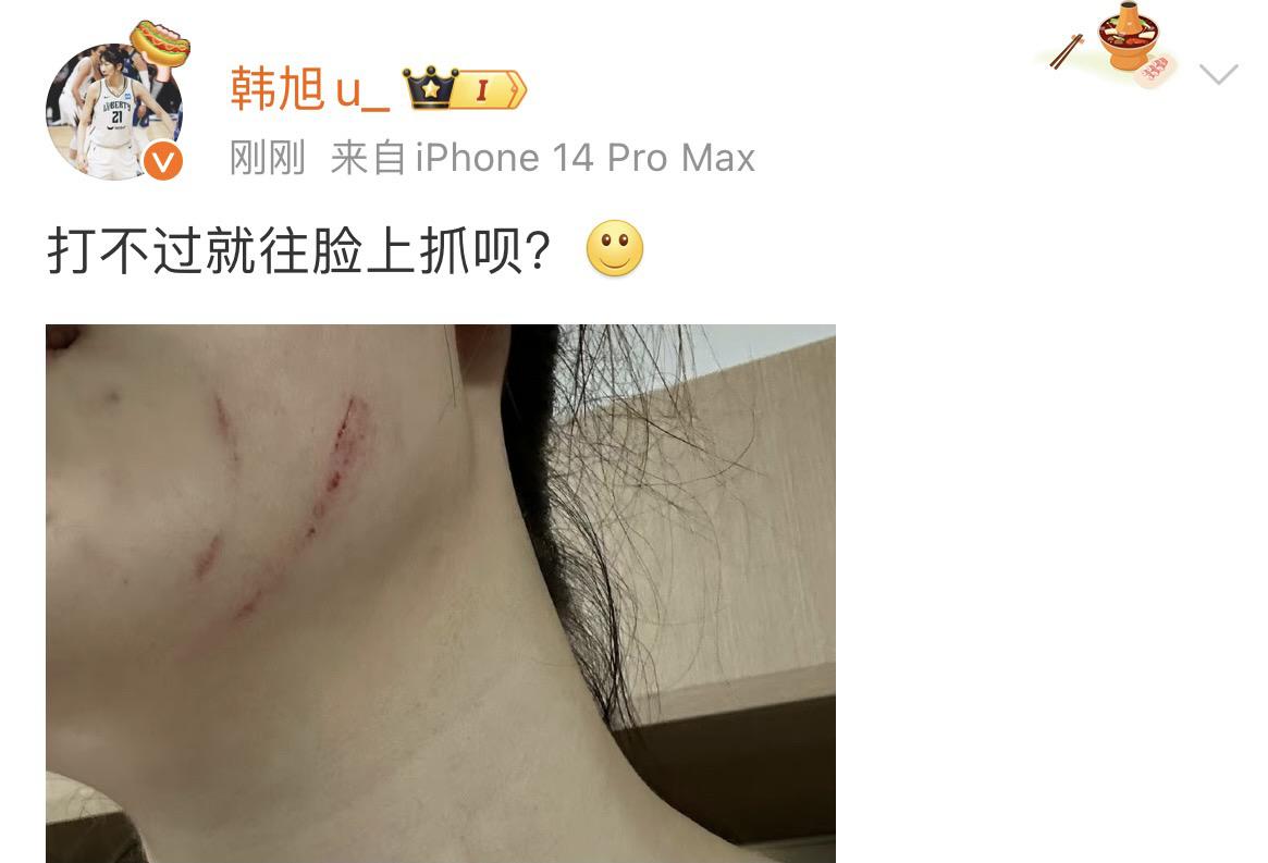 恶劣！女篮国手遭内蒙古球员恶意扇脸，脸蛋被抓破，晒出受伤证据(2)
