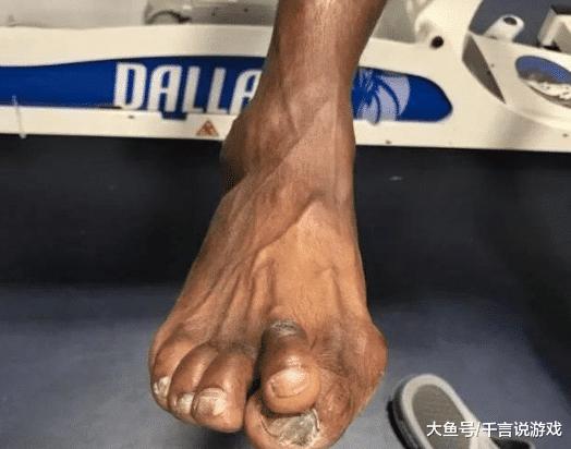 看到科比的跟腱，詹姆斯的脚趾，才知道联盟球星有多么的不容易(3)