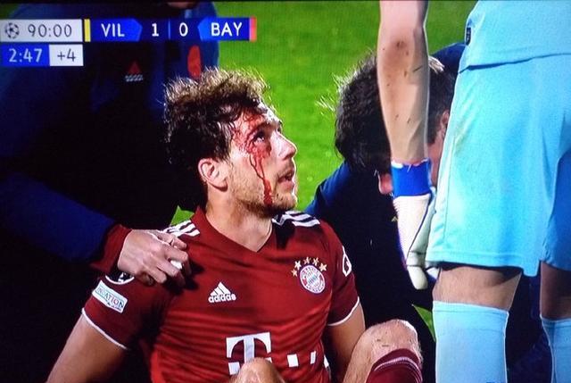 拜仁0-1爆冷，大将遭肘击满脸是血！埃梅里：超级自豪，争取晋级(2)