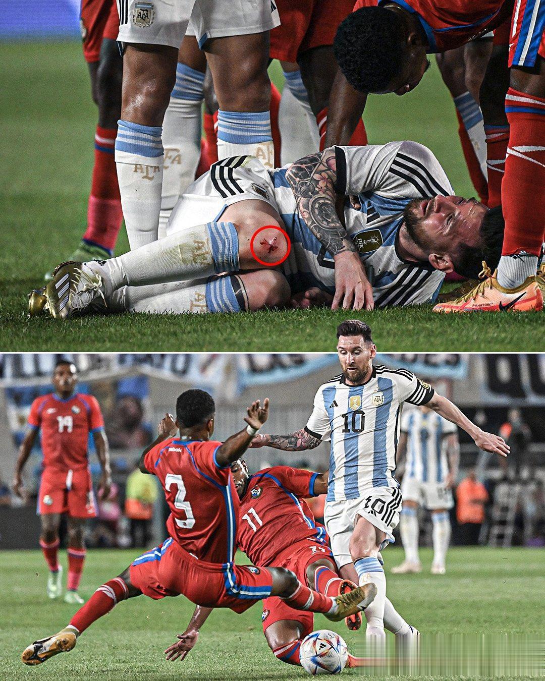一场友谊赛，巴拿马球员对梅西下脚真狠，把他的膝盖都踢伤了，鲜血直流。梅西也痛得龇