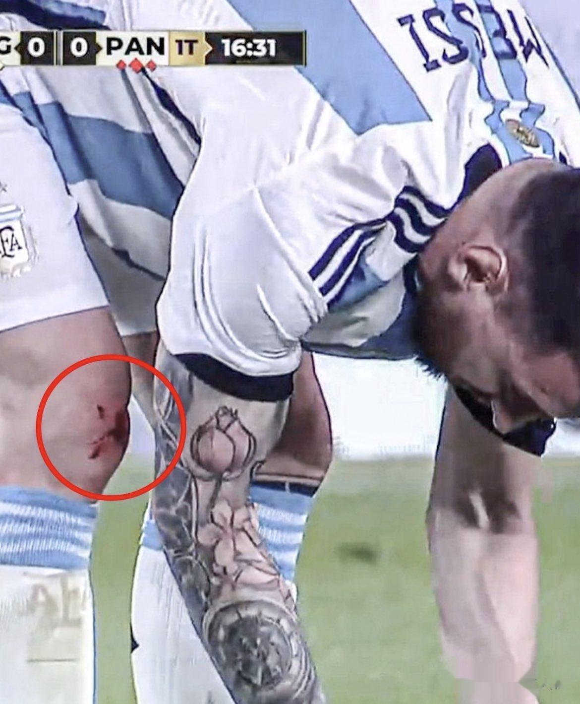 一场友谊赛，巴拿马球员对梅西下脚真狠，把他的膝盖都踢伤了，鲜血直流。梅西也痛得龇(2)